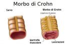 Cos’è il morbo di Crohn? Circa 5 milioni di persone ne sono affette Cos’è il morbo di Crohn? Circa 5 milioni di persone ne sono affette