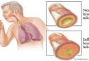 Come sbarazzarsi velocemente del muco nel petto e nella gola (risultato immediato con rimedi naturali) Come sbarazzarsi velocemente del muco nel petto e nella gola (risultato immediato con rimedi naturali)