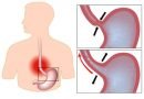 6 segnali che indicano che potresti soffrire di reflusso gastrico e come risolverlo 6 segnali che indicano che potresti soffrire di reflusso gastrico e come risolverlo