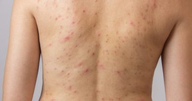 3 rimedi naturali fai da te contro l’acne posteriore 3 rimedi naturali fai da te contro l’acne posteriore
