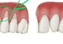Fai crescere le gengive ritirate con questi rimedi naturali Fai crescere le gengive ritirate con questi rimedi naturali