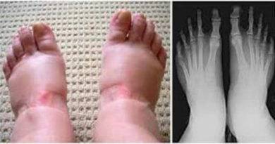 Piedi gonfi? Ecco 5 ragioni per cui non dovresti mai ignorare questo sintomo Piedi gonfi? Ecco 5 ragioni per cui non dovresti mai ignorare questo sintomo