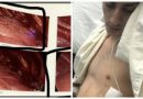 Diciottenne rischia di morire a causa della sigaretta elettronica – Adesso mostra le macchie nere sul polmone per incoraggiare gli utilizzatori a smettere Diciottenne rischia di morire a causa della sigaretta elettronica – Adesso mostra le macchie nere sul polmone per incoraggiare gli utilizzatori a smettere
