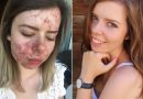 Ragazza svela sui social il suo segreto per riuscire ad eliminare le impurità del viso Ragazza svela sui social il suo segreto per riuscire ad eliminare le impurità del viso