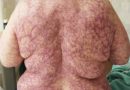 La donna esposta al freddo si ritrova con una tremenda eruzione cutanea – La foto diventa virale e sta causando preoccupazioni La donna esposta al freddo si ritrova con una tremenda eruzione cutanea – La foto diventa virale e sta causando preoccupazioni
