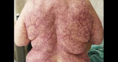 La donna esposta al freddo si ritrova con una tremenda eruzione cutanea – La foto diventa virale e sta causando preoccupazioni La donna esposta al freddo si ritrova con una tremenda eruzione cutanea – La foto diventa virale e sta causando preoccupazioni