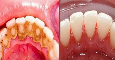 Placca: ecco alcuni semplici trucchi casalinghi che ti fanno evitare temporaneamente “la poltrona del dentista” Placca: ecco alcuni semplici trucchi casalinghi che ti fanno evitare temporaneamente “la poltrona del dentista”
