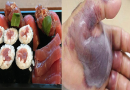 Il medico è costretto ad amputare la mano dell’uomo – Dopo aver mangiato un piatto di sushi ha contratto una rara infezione Il medico è costretto ad amputare la mano dell’uomo – Dopo aver mangiato un piatto di sushi ha contratto una rara infezione