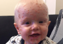 Pensa che il figlio avesse la varicella, quando il dottore lo esamina scopre che è affetto da una malattia rara Pensa che il figlio avesse la varicella, quando il dottore lo esamina scopre che è affetto da una malattia rara